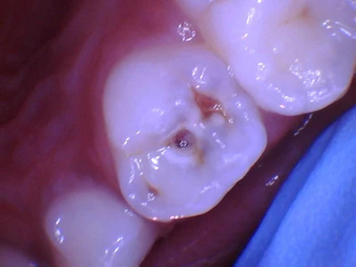 Figure 1: Large caries on the upper first primary molar.