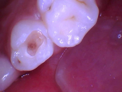 Figure 2: Selective caries removal.