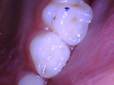 Figure 3: Tooth restored with A2 Luna 2 composite resin.