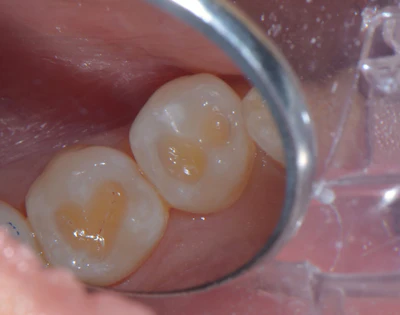 Figure 1: Preparation of class I caries on two lower premolars.
