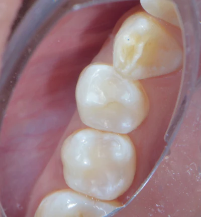 Figure 2: Immediate post-op, after placement in class I restorations on both lower premolars.