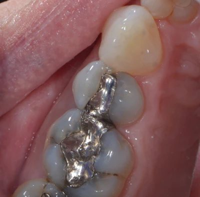 Figure 3: Upper premolar with failing disto-occlusal amalgam restoration.