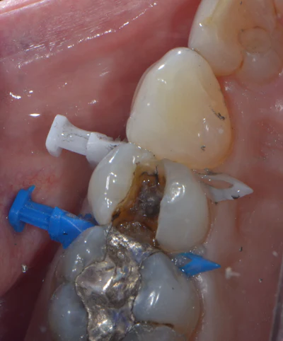 Figure 4: Upper premolar with amalgam removal completed under Isolite (Zyris) isolation. Crack on the mesial is visualized.
