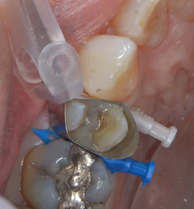 Figure 5: Upper premolar with sectional automatrix showing the base layer of Visalys Bulk Flow as an initial increment after 35% phosphoric acid selective etch (Select HV Etch, Bisco) and universal adhesive (All Bond Universal, Bisco). Masking of the underlying dark dentin was achieved with this layer.