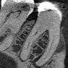 Figure 1: CBCT, sagittal view (tooth #30).