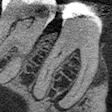 Figure 1: CBCT, sagittal view (tooth #30).