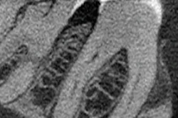 Figure 1: CBCT, sagittal view (tooth #30).