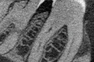 Figure 1: CBCT, sagittal view (tooth #30).