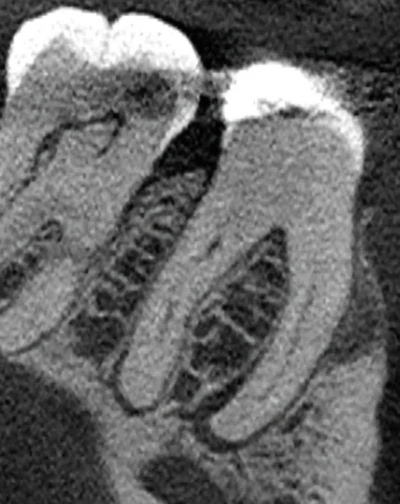 Figure 1: CBCT, sagittal view (tooth #30).