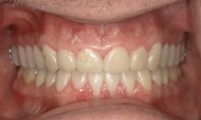 Figures 1 and 2: Reconstruction cases like these, especially for patients who have exhibited a lifetime of heavy bruxism, require an extremely strong temporary material, not only because of the long span but also because of the potential for prolonged wear of the provisional dentistry.