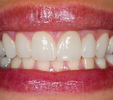 Teeth Veneers