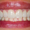 Teeth Veneers