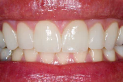 Teeth Veneers