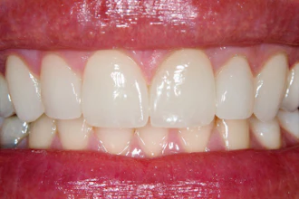 Teeth Veneers