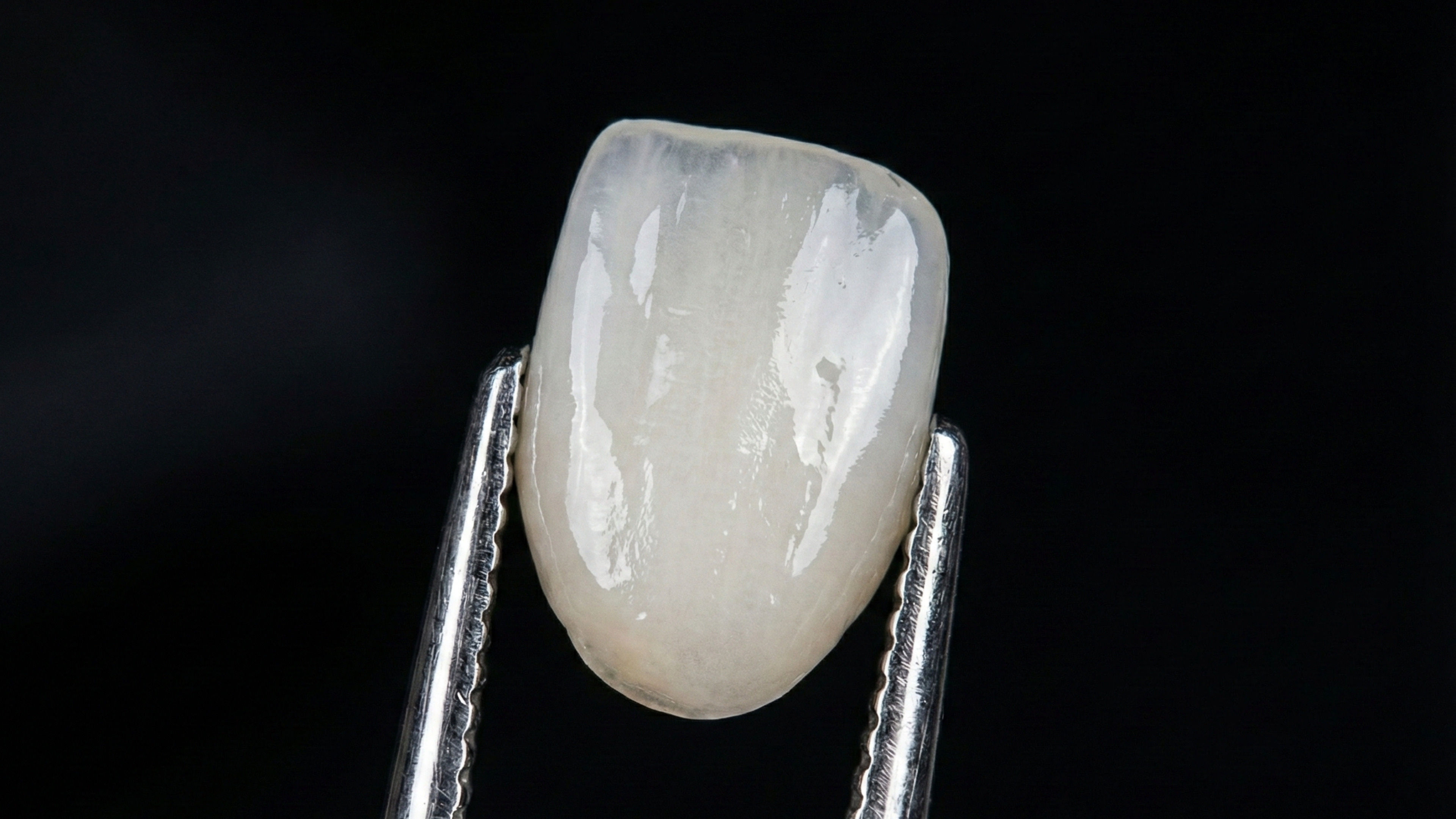 Tooth Veneer Mrs Jpeg