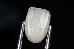 Tooth Veneer Mrs Jpeg