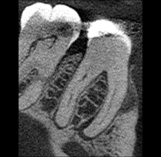 2026 04 30 40 Yo Woman Lesion Endo Insider 400