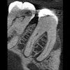 2026 04 30 40 Yo Woman Lesion Endo Insider 400