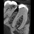 2026 04 30 40 Yo Woman Lesion Endo Insider 400