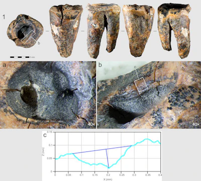 Fig 1. General view of the tooth in five projections. (a–c) Macro-photographs of the crown’s occlusal surface features: (a.) superior view of the concavity; (b.) stepped groove on the concavity’s wall; (c.) cross-sectional profile of the groove.
