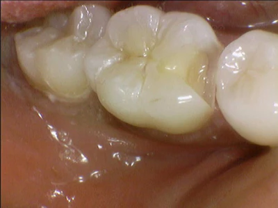 Figure 2: Tooth #30 class II prep. This box was about 5-6 mm in depth. Visalys Bulk Flow was used at the base of the box for about 1-2mm. The rest of the prep was completed in one increment using Visalys Bulk Fill.