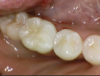 Figure 3: Final restoration. Great shade match; the chameleon system aided with ease of use and time efficacy. The surface was easy to polish, and a high gloss finish was achieved.