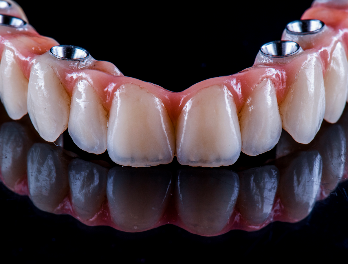 Arch Bridge Implant