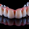 Arch Bridge Implant