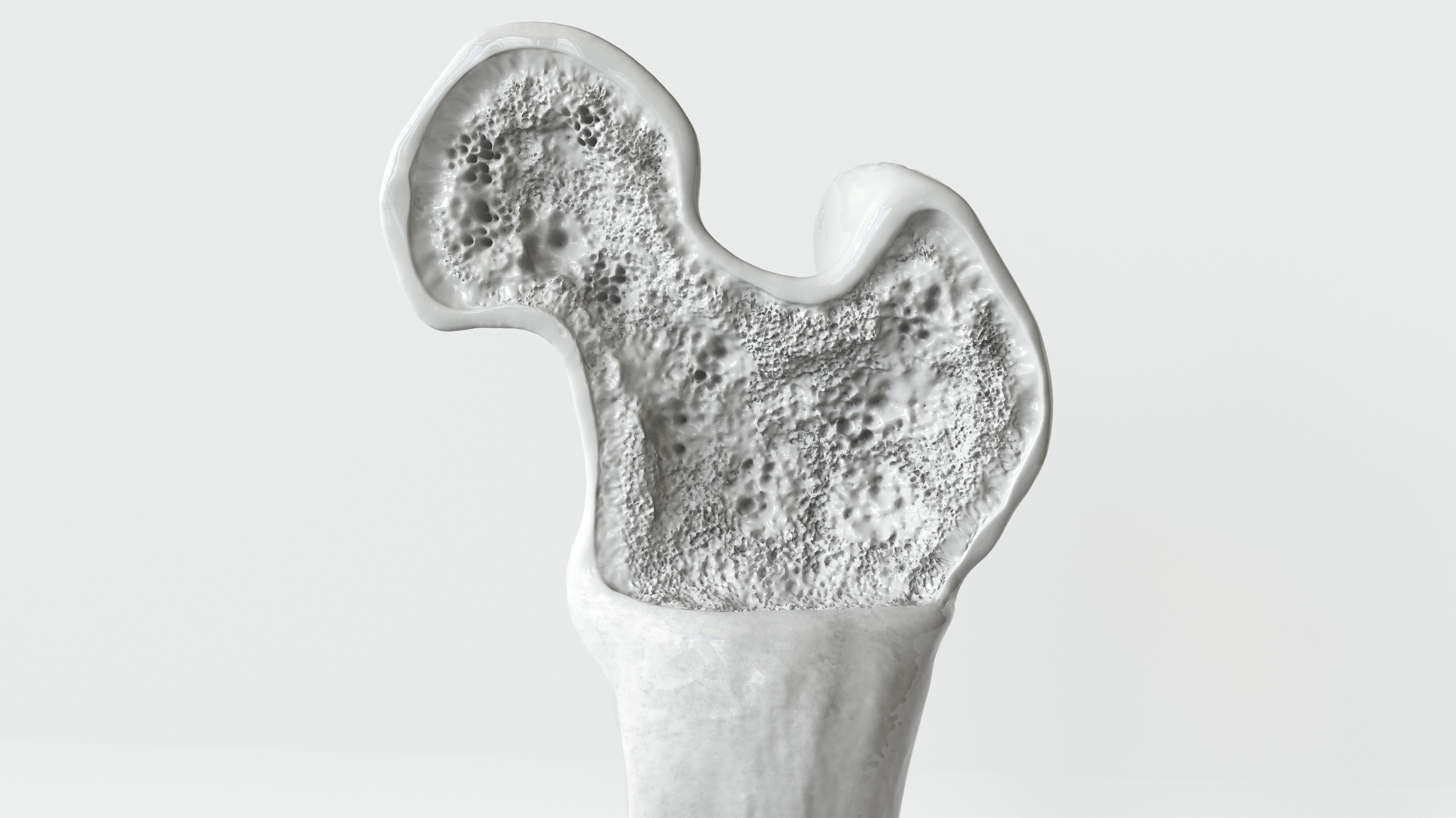 Bone Density Crevis