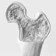 Bone Density Crevis