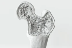 Bone Density Crevis