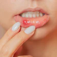 Mouth Ulcer Woman ольга шефер