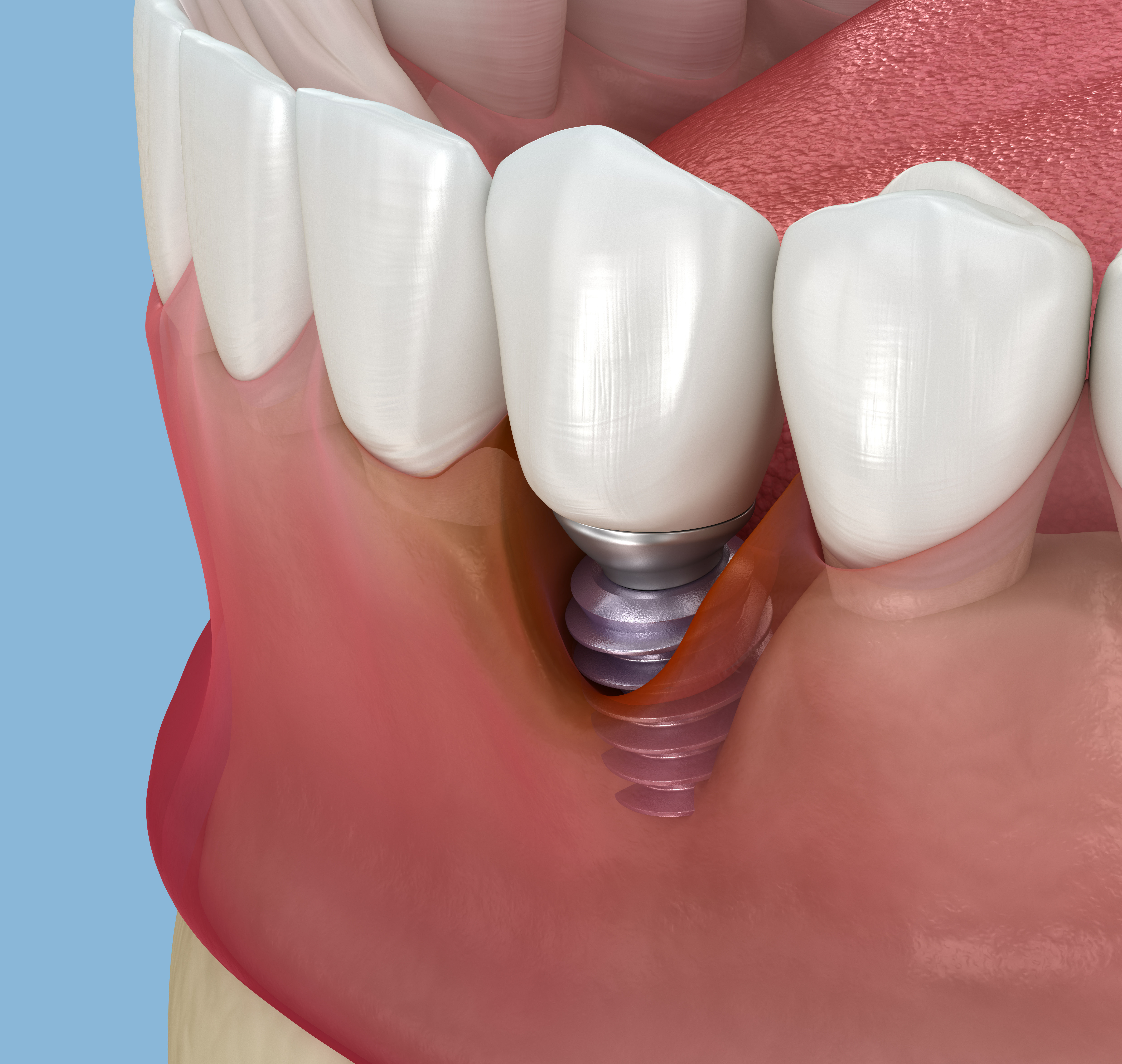 Peri Implantitis Alex Mit