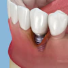 Peri Implantitis Alex Mit