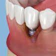 Peri Implantitis Alex Mit