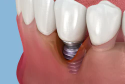 Peri Implantitis Alex Mit
