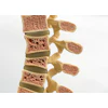 Spine Osteoporosis Leesle
