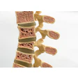 Spine Osteoporosis Leesle