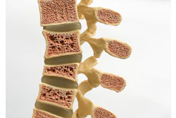 Spine Osteoporosis Leesle
