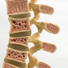 Spine Osteoporosis Leesle