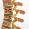 Spine Osteoporosis Leesle