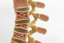 Spine Osteoporosis Leesle