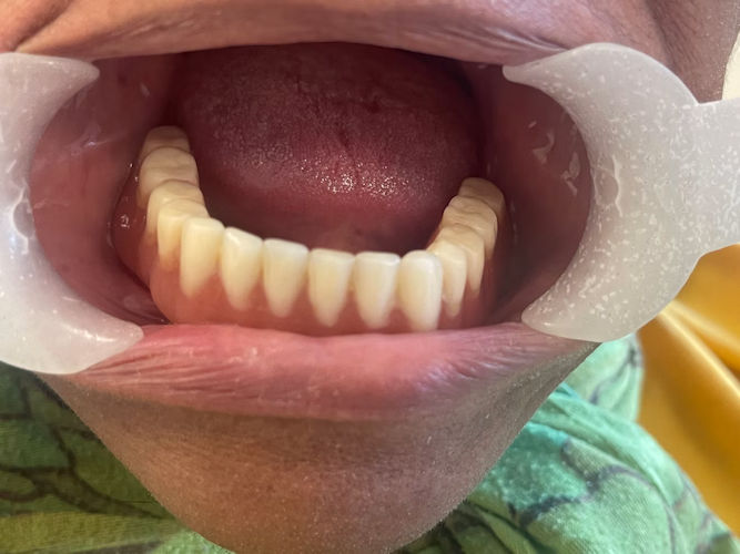 The implant-supported mandibular overdenture post-installation. Besides benefits such as improved chewing ability and stability, patients reported greater confidence.