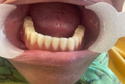 The implant-supported mandibular overdenture post-installation. Besides benefits such as improved chewing ability and stability, patients reported greater confidence.