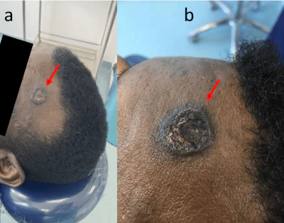 Figure 1: Extraoral clinical presentation of the lesion. (a) General view showing the lesion on the left frontal region. (b) Close-up view demonstrating a solitary, well-defined, indurated ulcerative lesion with a crusted surface. The lesion was asymptomatic and was incidentally identified during extraoral examination, leading to the diagnosis of primary syphilis.