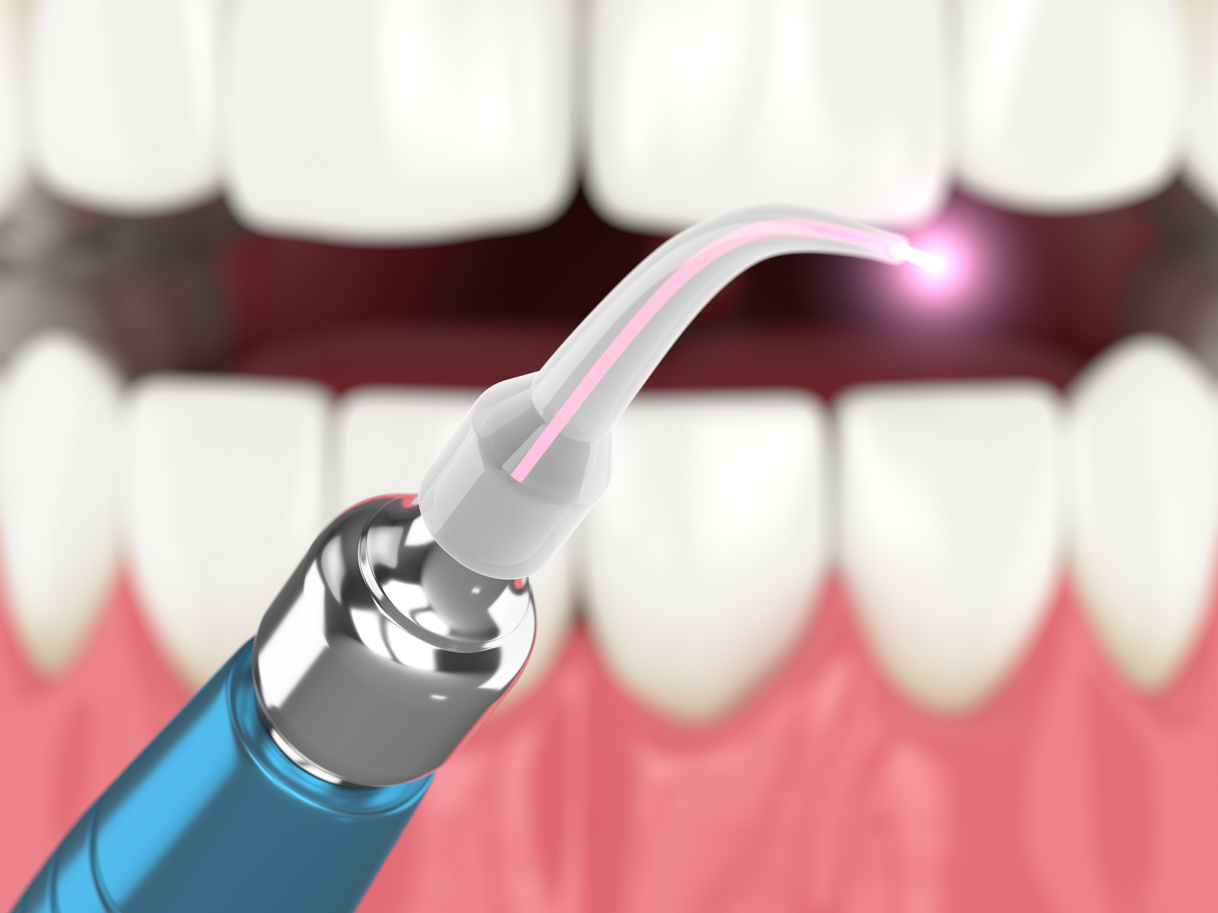 Dental Laser