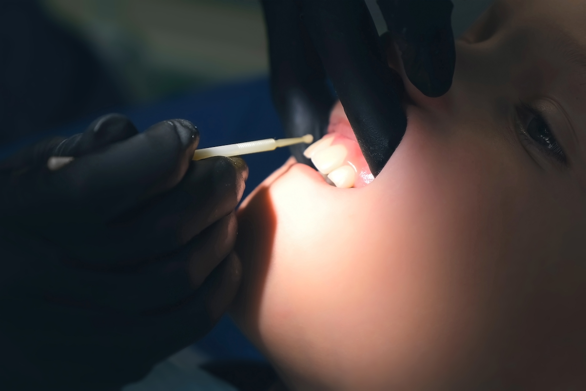 Fluoride Application Closeup