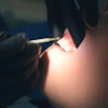 Fluoride Application Closeup