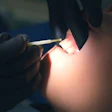 Fluoride Application Closeup