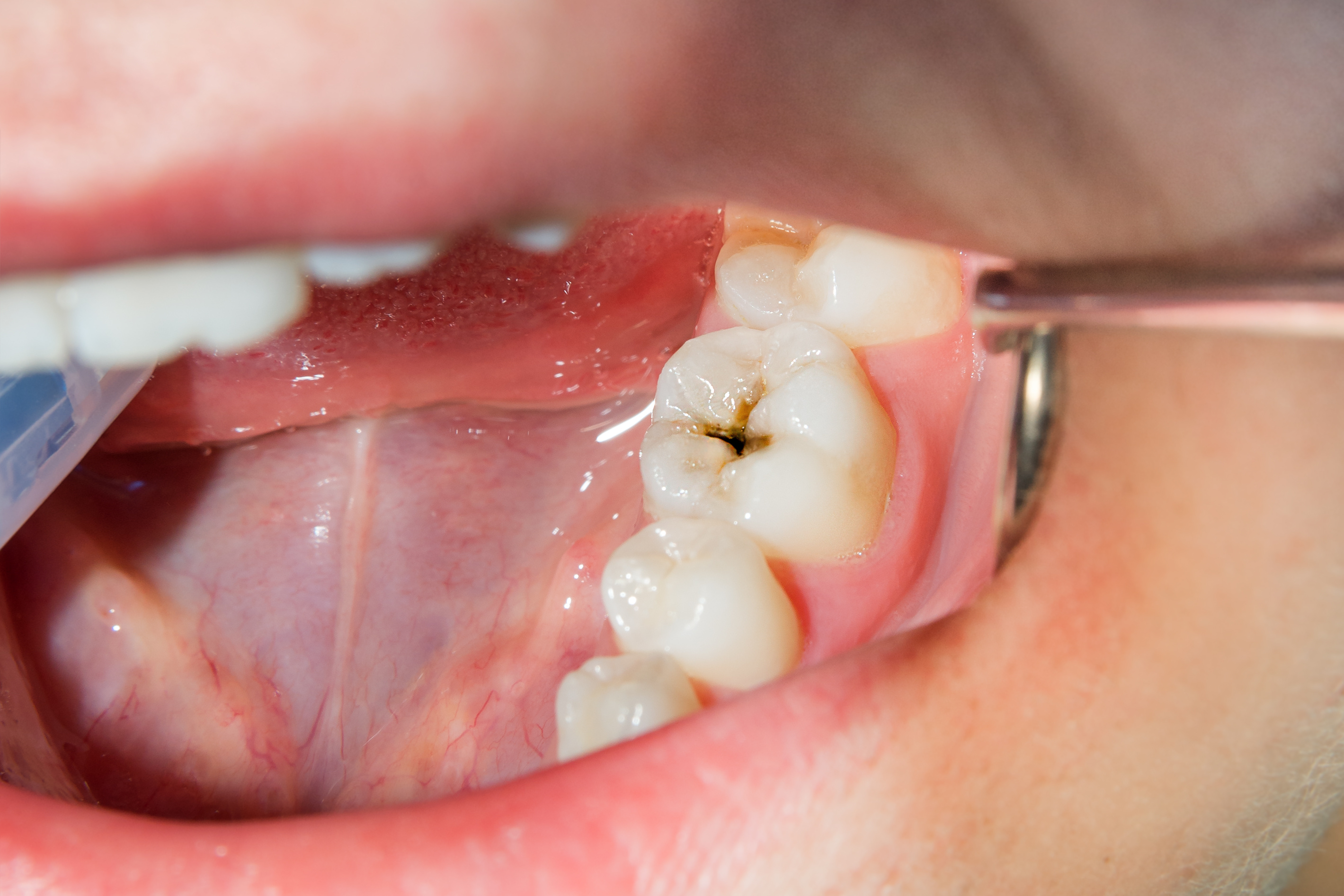 Tooth Caries Cavity